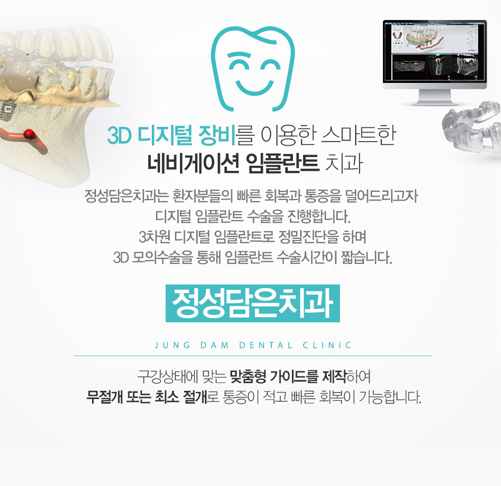 3D 디지털 장비를 이용한 스마트한 네비게이션 임플란트 치과