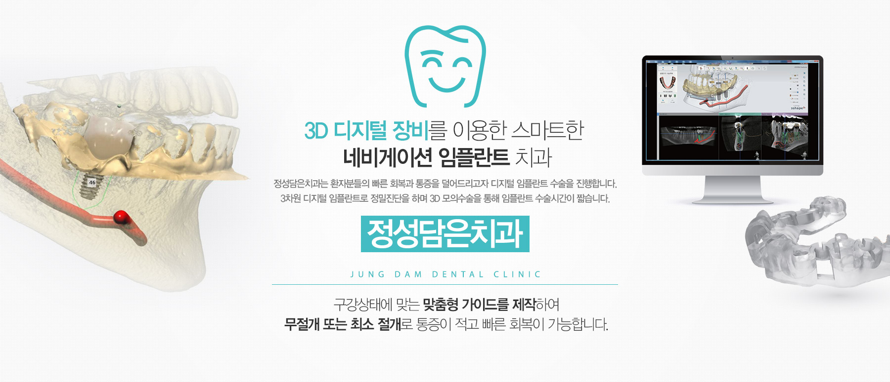 3D 디지털 장비를 이용한 스마트한 네비게이션 임플란트 치과