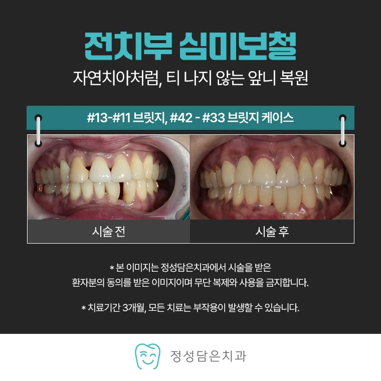 청천동치과 자연스러운 미소를 만드는 전치부 심미보철