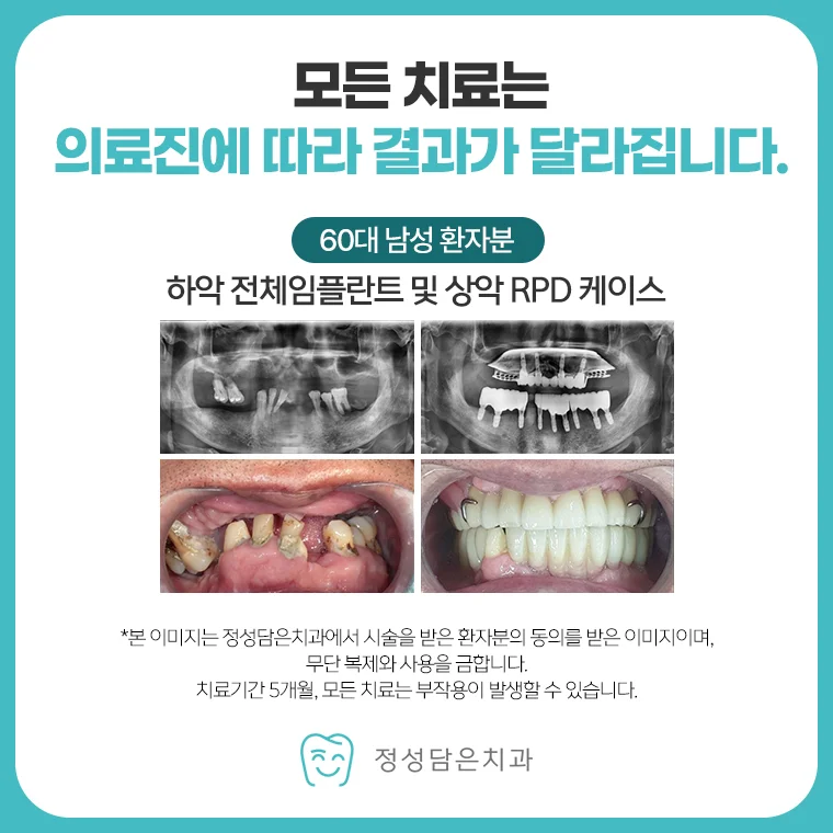 무절개 임플란트, 잇몸을 절개하지 않으면 누구나 받을 수 있을까요?