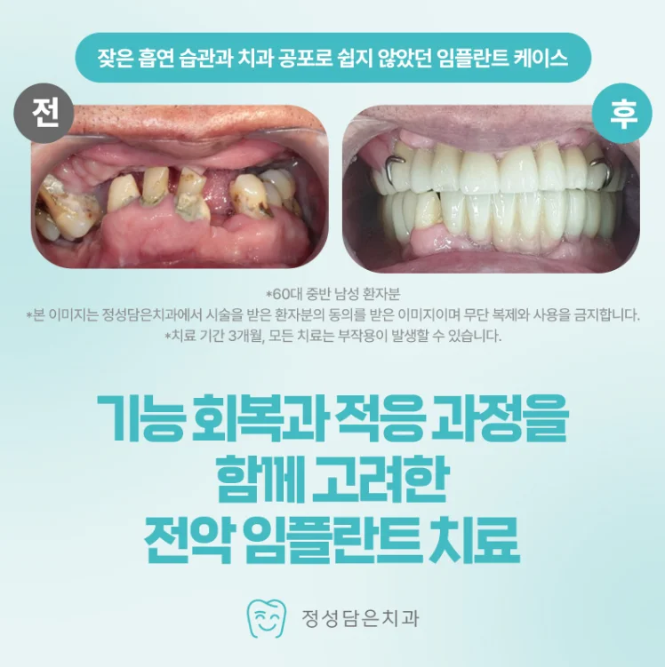 부평임플란트 재수술, 실패 원인을 찾는 것이 먼저