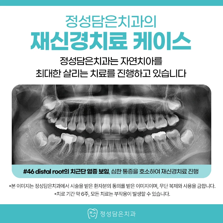 부평재신경치료, 치료 받았던 치아가 다시 아프다면 바로 뽑아야 할까?
